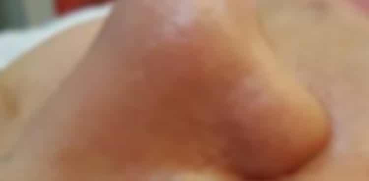a close up of a nose after cytopeel