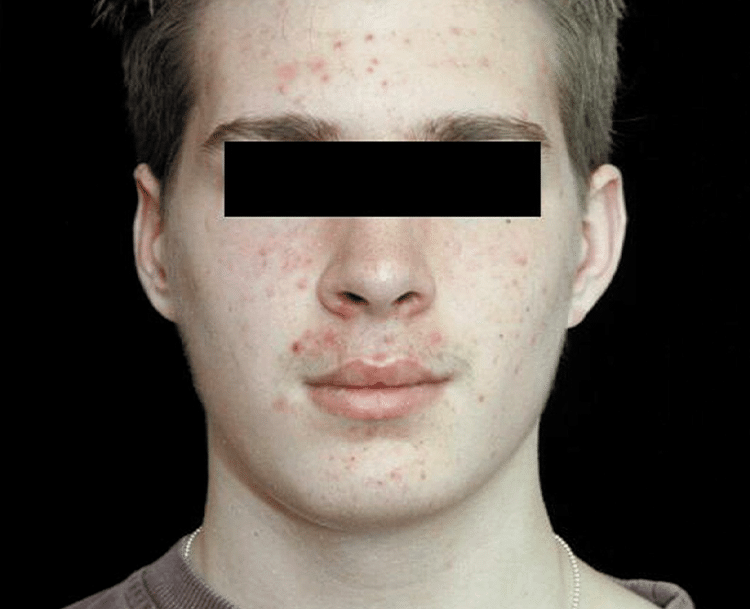 a close up of a man looking at the camera with skin spots