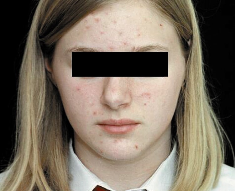 a close up of a woman with skin spots
