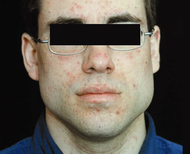 a close up of a man wearing glasses and looking at the camera with skin spots