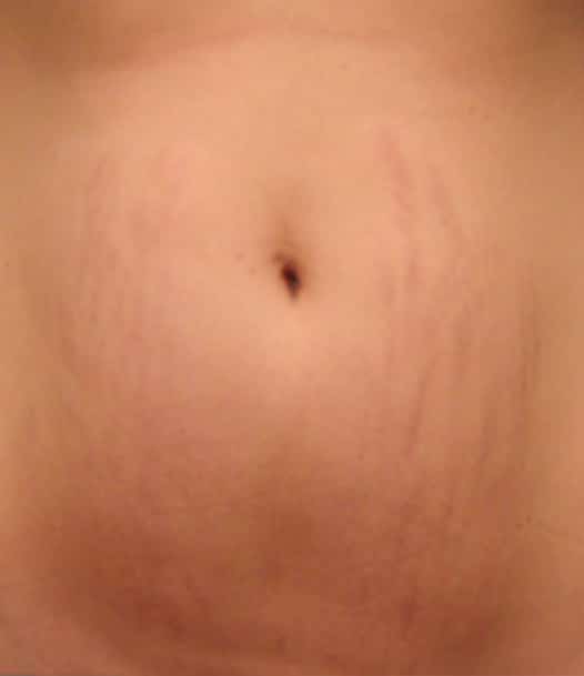stretch marks on a belly after Stemfacial