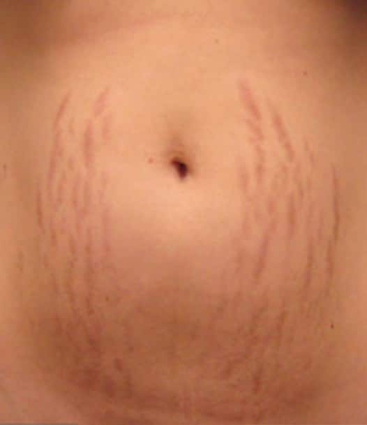 stretch marks on a belly