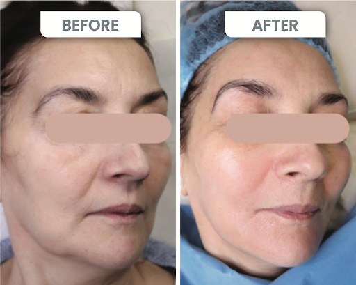 Before and after cosmetic treatment on a woman’s face showing smoother skin, lifted brow, and wrinkle reduction results