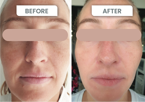 Side-by-side before and after facial treatment of a woman, showing smoother skin and reduced redness.